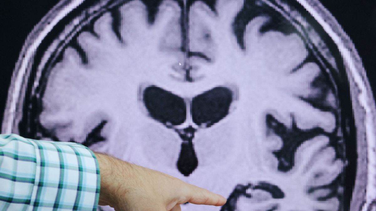 Debate sobre el alzhéimer: si no se puede curar, ¿para qué diagnosticar temprano?