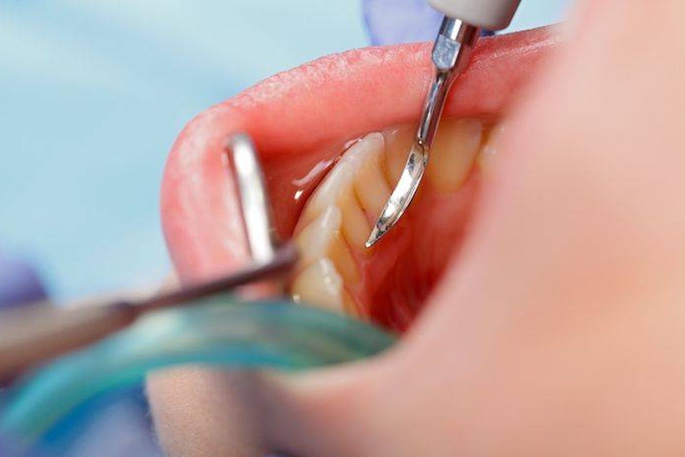 El curetaje dental es un complicado proceso de limpieza dental. (Foto: Clinica dental Avodent)
