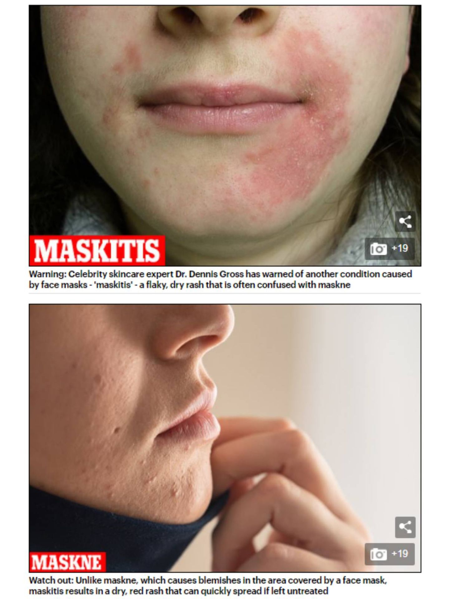 Imagen de un caso de maskitis frente uno de maské en el artículo del Daily Mail 'Are YOU suffering from 'maskitis'? 