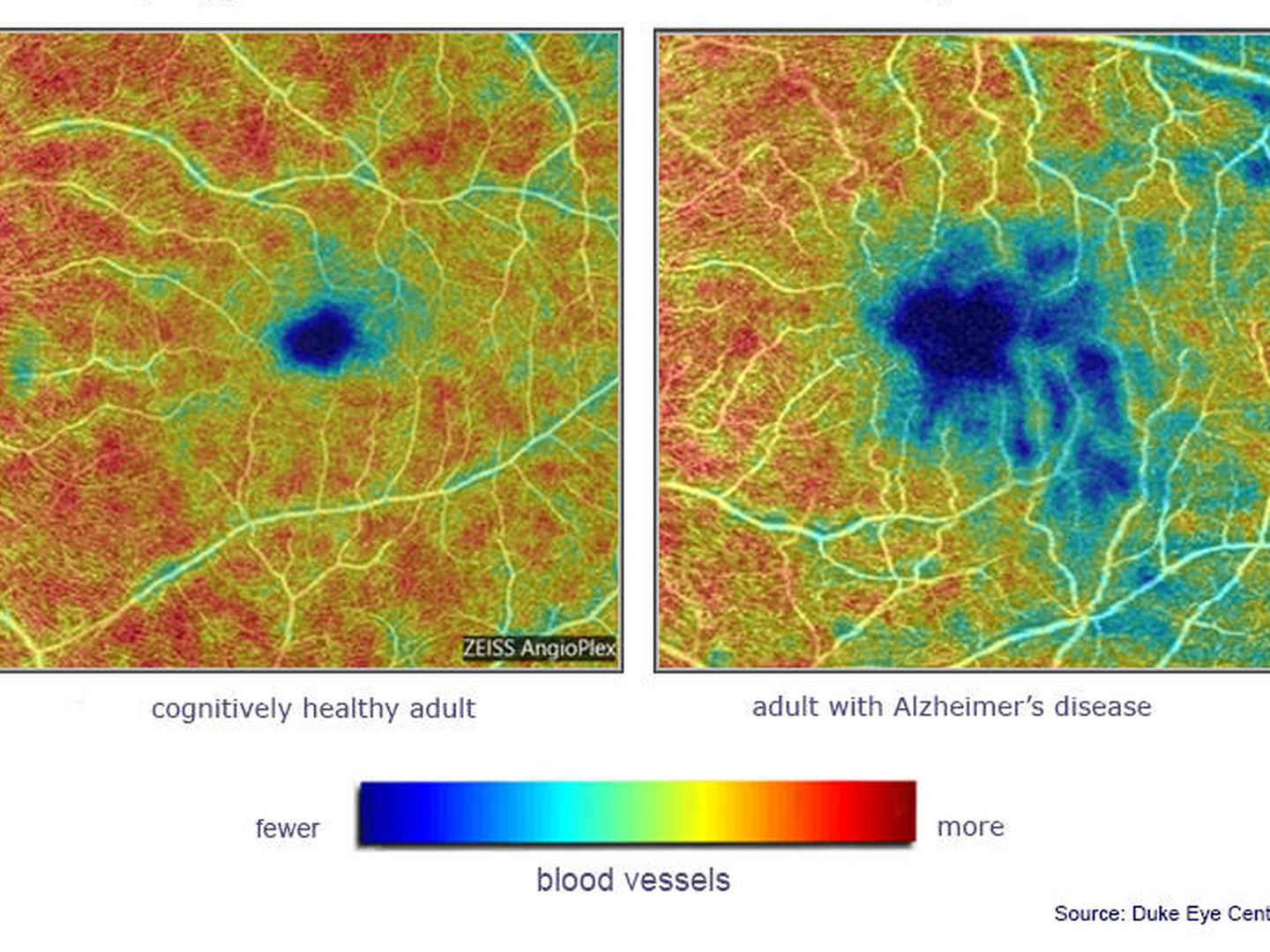 Comparación en los vasos sanguíneos de una persona sana y una con alzhéimer (Duke Eye Center)