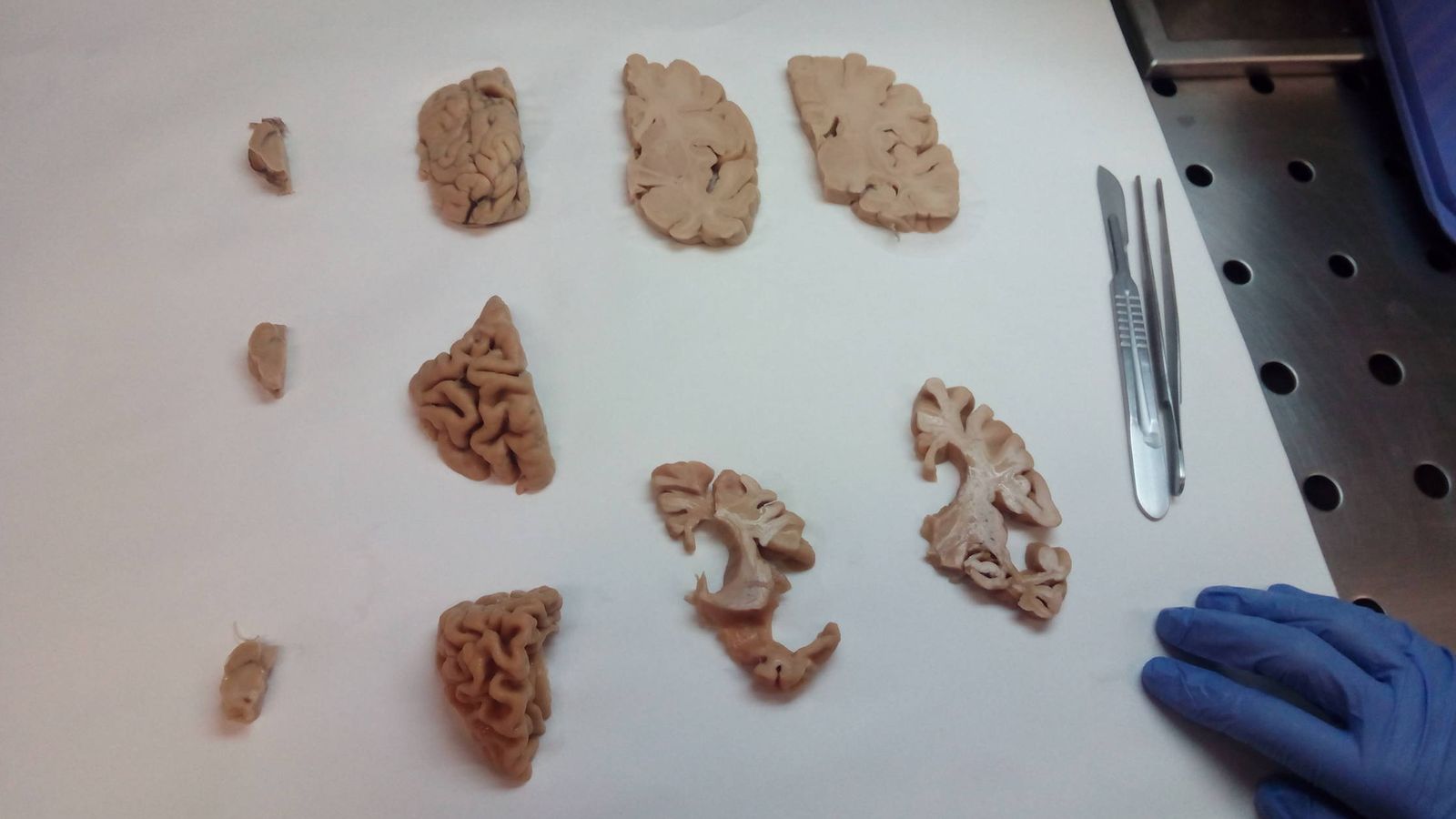 Secciones de cerebro que han padecido párkinson y alzhéimer. (EFE)