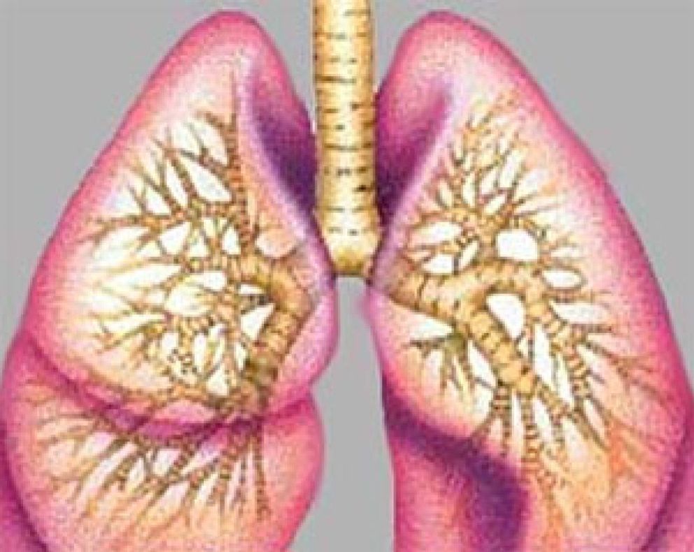 Foto: La EPOC triplica las posibilidades de padecer cáncer de pulmón