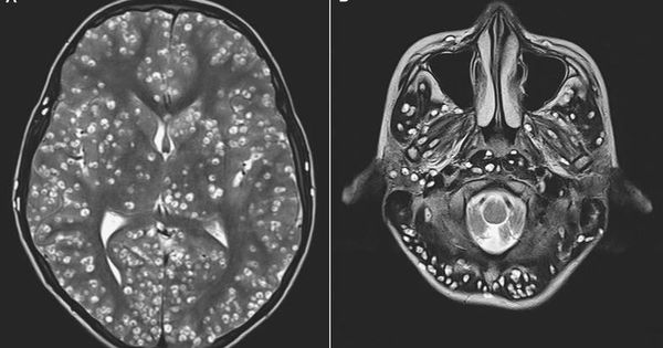 Foto: Resonancia del cerebro (A) y cerebelo (B) del paciente. (Hospital ESIC, Faridabad, India)