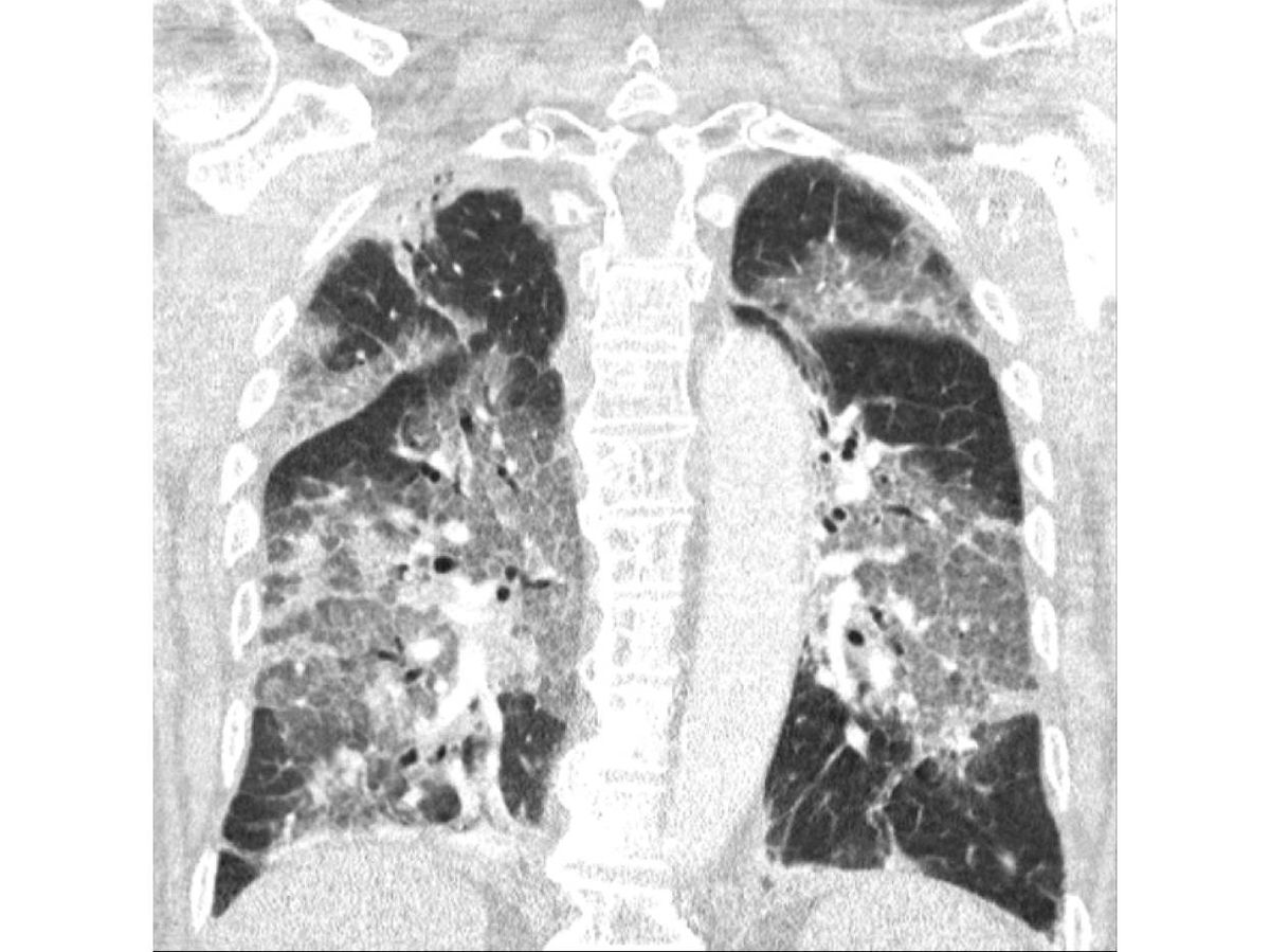 Foto: El escáner muestra los daños producidos por el covid-19 en los pulmones. (Zuyderland Medical Center)