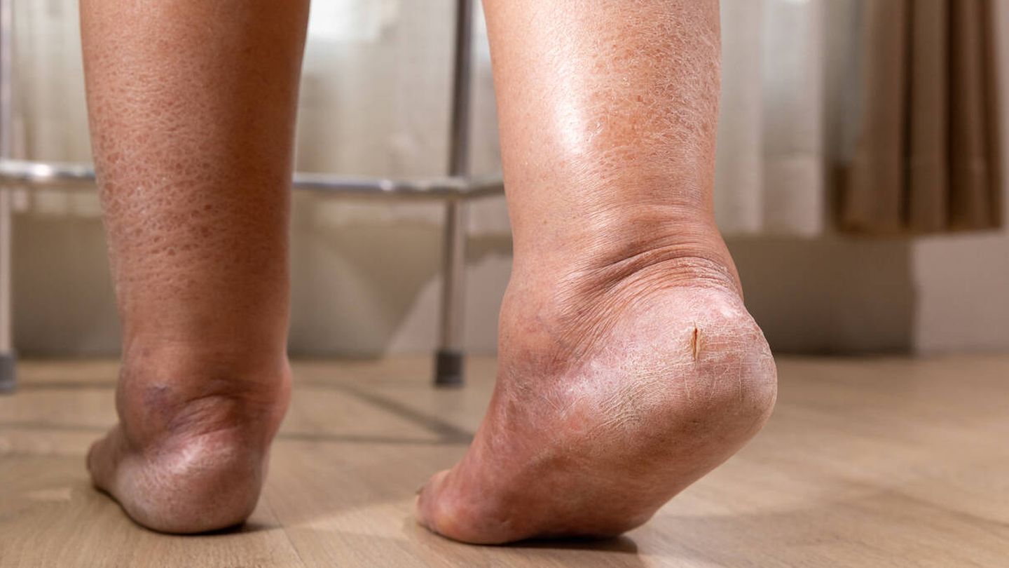 El pie diabético es una de las grandes complicaciones de la enfermedad metabólica. (iStock)