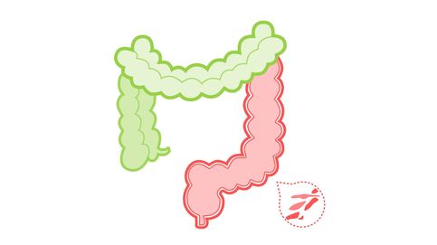 Síndrome del intestino irritable: causas, síntomas y remedios