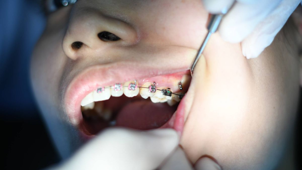 Una patente caducada dispara las ortodoncias en España (pero cuidado con las gangas)