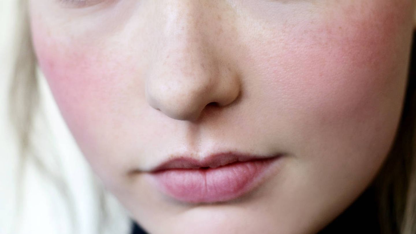 Algunos cosméticos para el cuidado de la piel con acné pueden resultar fotosensibilizantes. (Imaxtree)