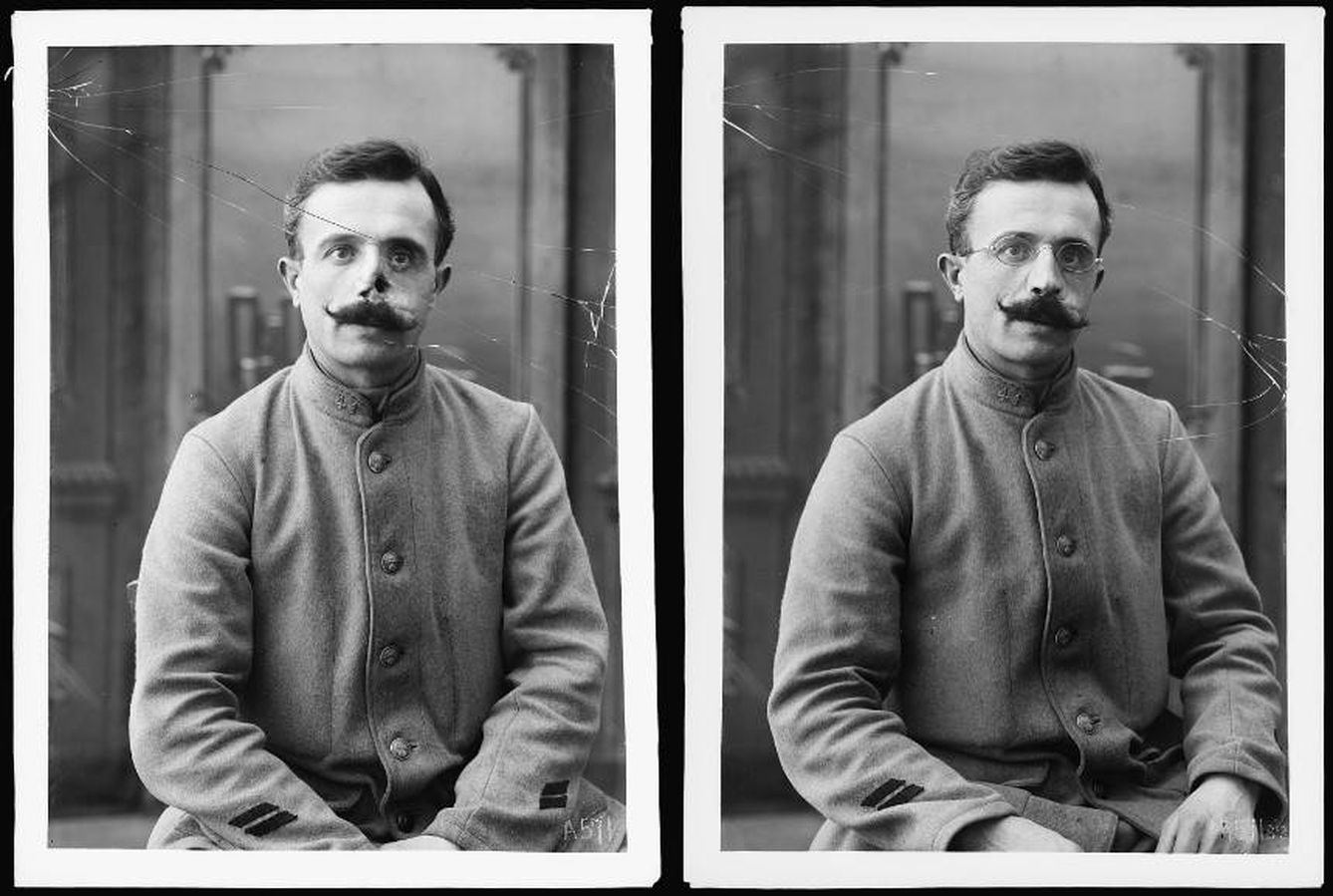 Un soldado sin la máscara y con su posterior colocación (Library of Congress)