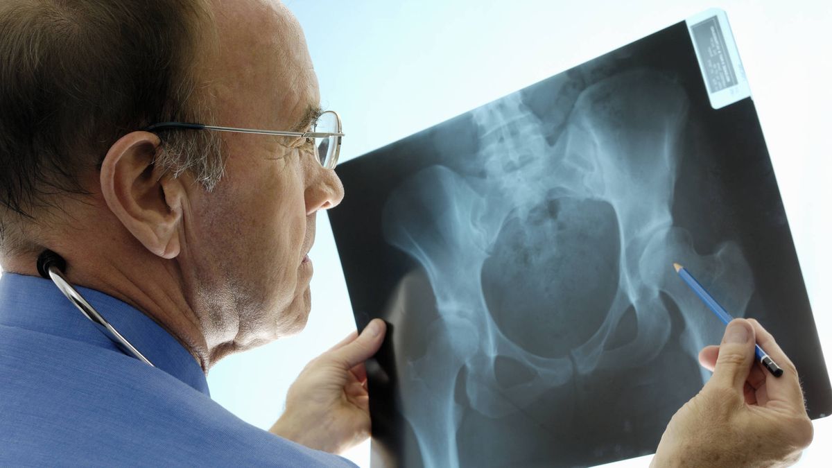Las 5 cosas que nadie te suele contar sobre la osteoporosis