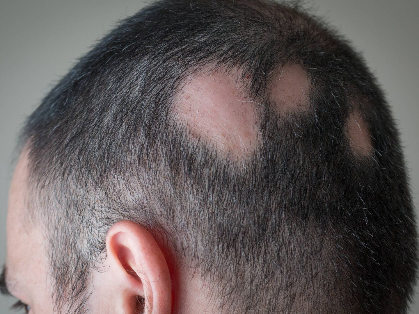 Alopecia areata (Foto: iStock.)
