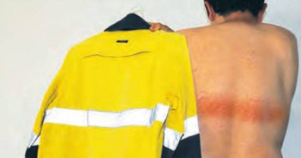Foto: La banda provocó quemaduras de primer grado en la espalda del trabajador (Foto: Medical Journal of Australia)
