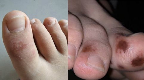 ¿Te han salido erupciones en pies y manos? El síntoma menos conocido del coronavirus