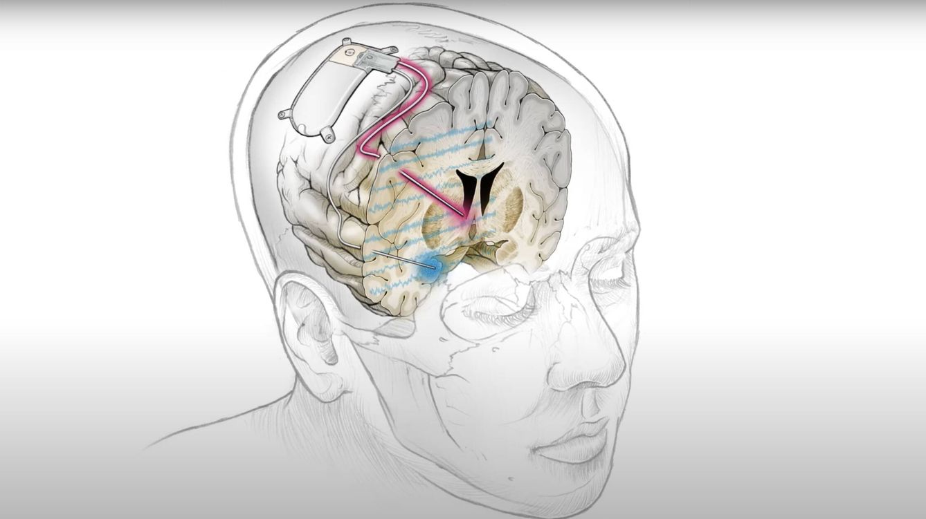 Foto: Un nuevo implante cerebral que ha sido capaz de tratar con éxito la depresión.  (UCFS)