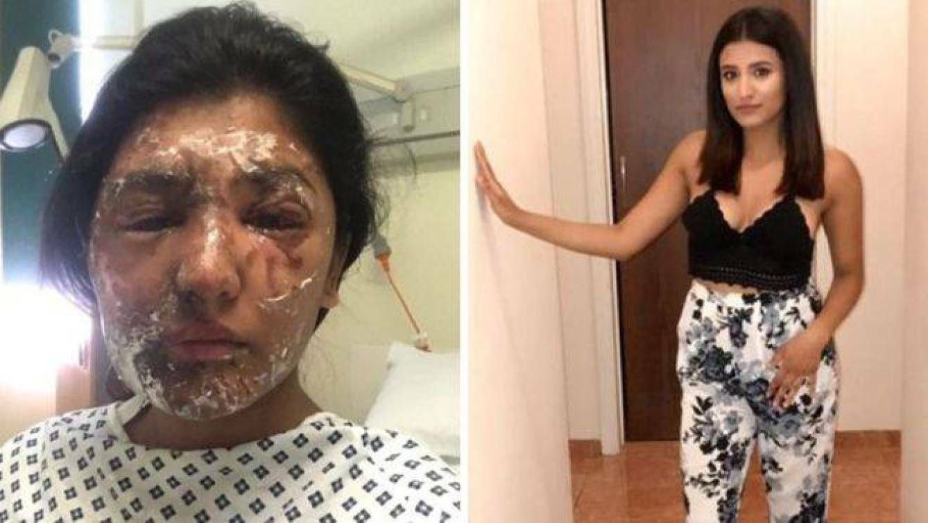 Resham Khan, antes y después del ataque con ácido