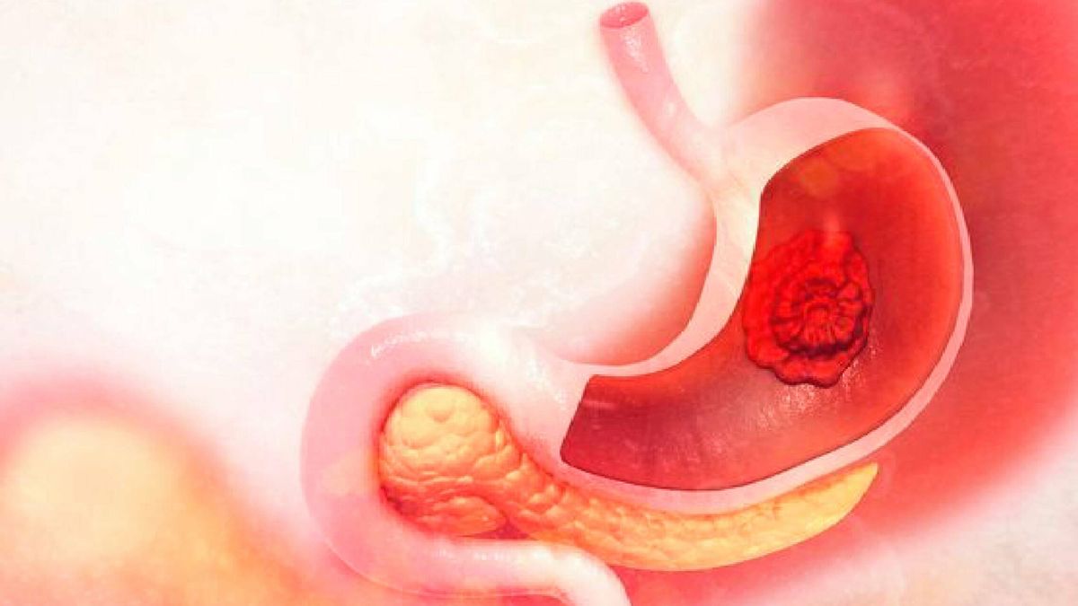 Cáncer de estómago: síntomas y tratamiento de una enfermedad silenciosa