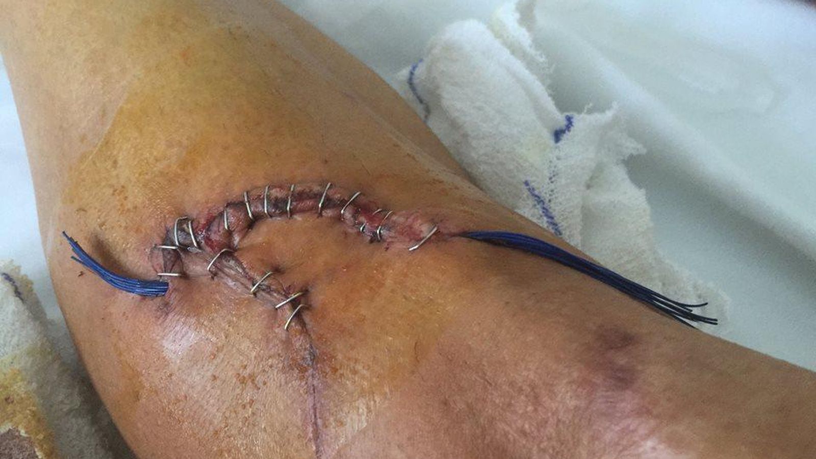 Foto: Tremenda imagen de la herida que le provocaron a Fran Ventoso los frenos de disco (FOTOS: www.facebook.com/fran.ventoso)
