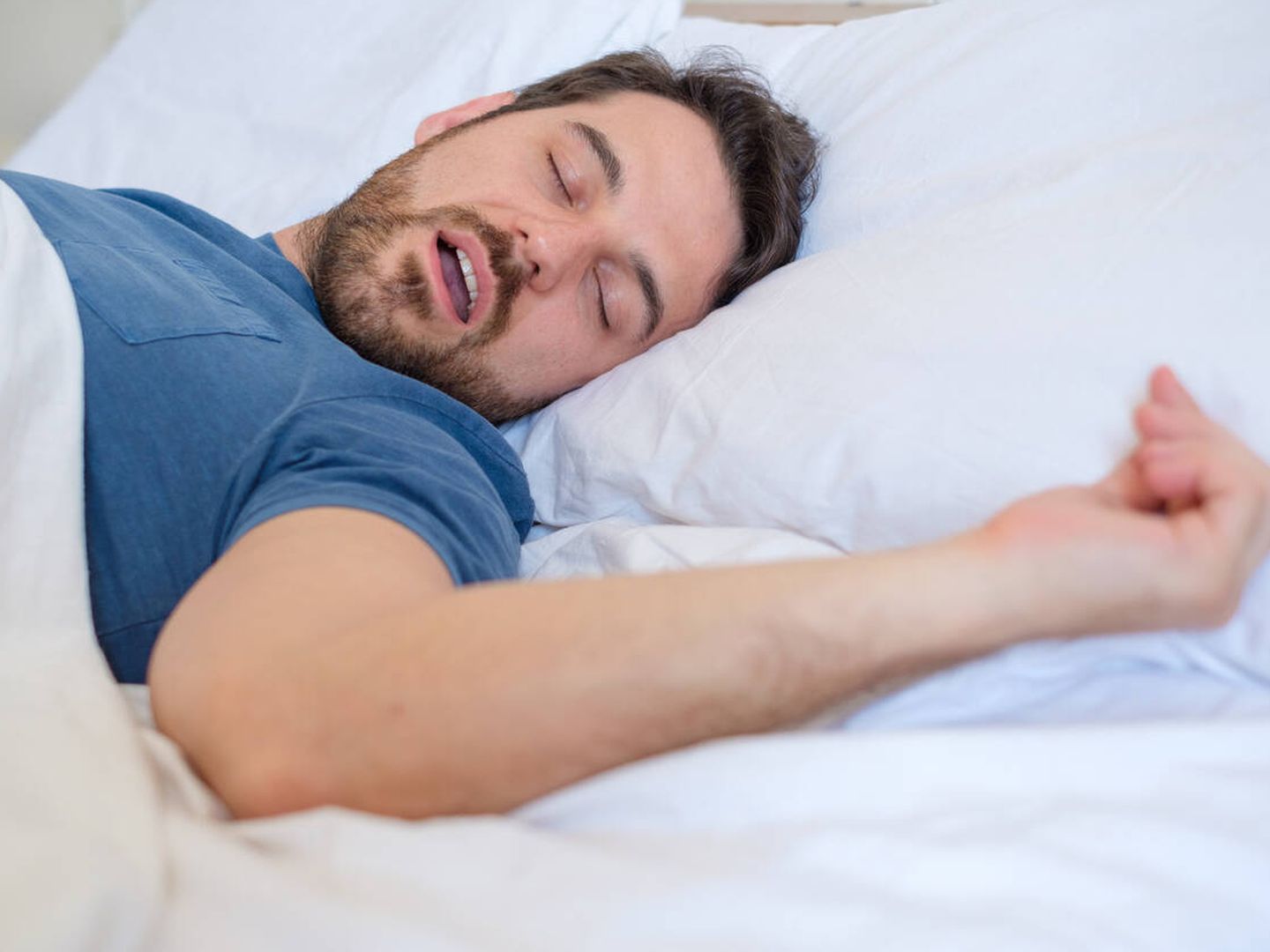 Los ronquidos son uno de los síntomas más leves de la apnea del sueño. (iStock)