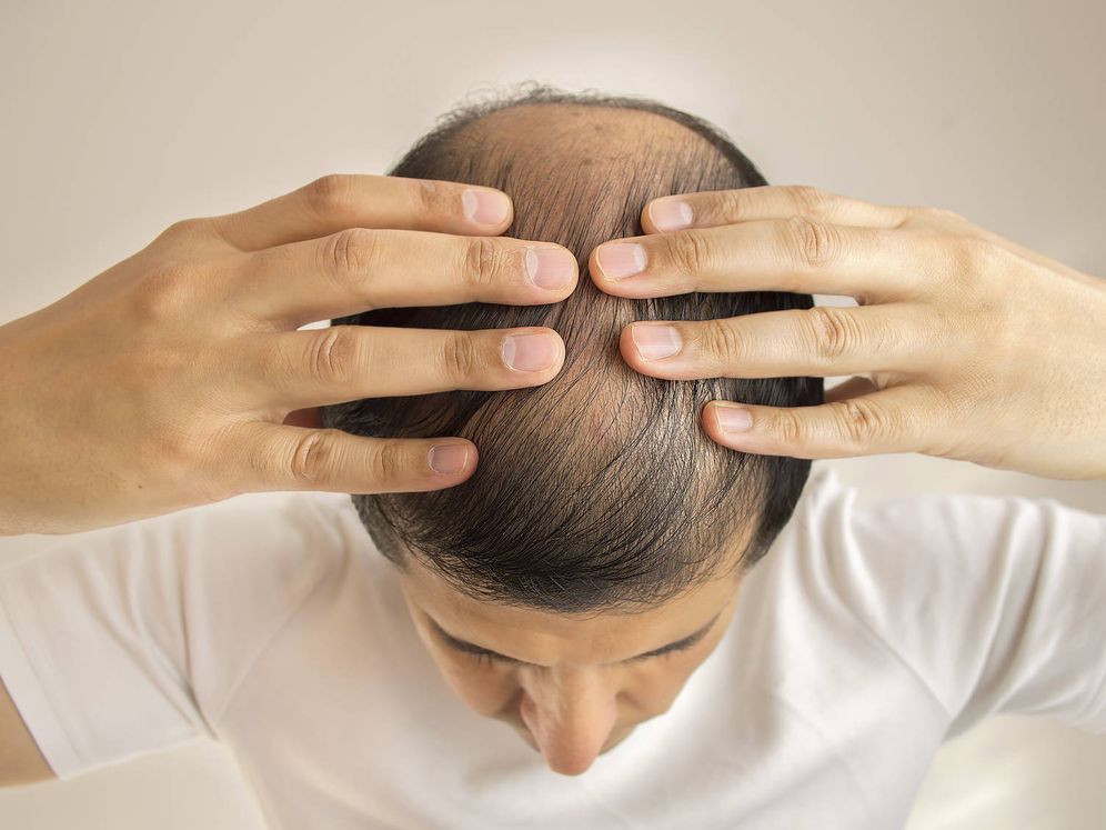 Foto: La alopecia afecta más a las personas que trabajan más de 52 horas a la semana