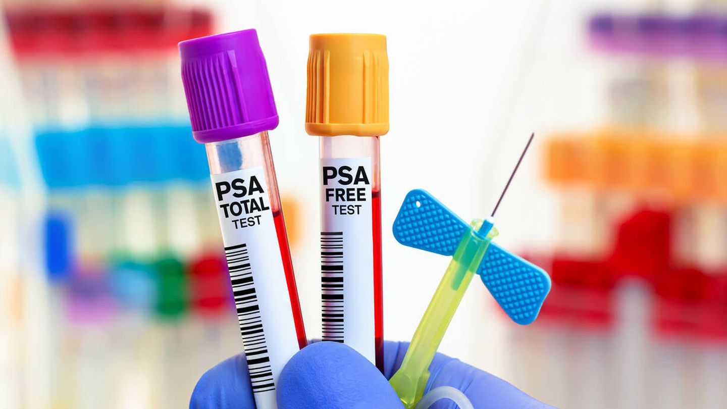 La determinación del PSA es un test rutinario para detectar cáncer de próstata. (iStock)