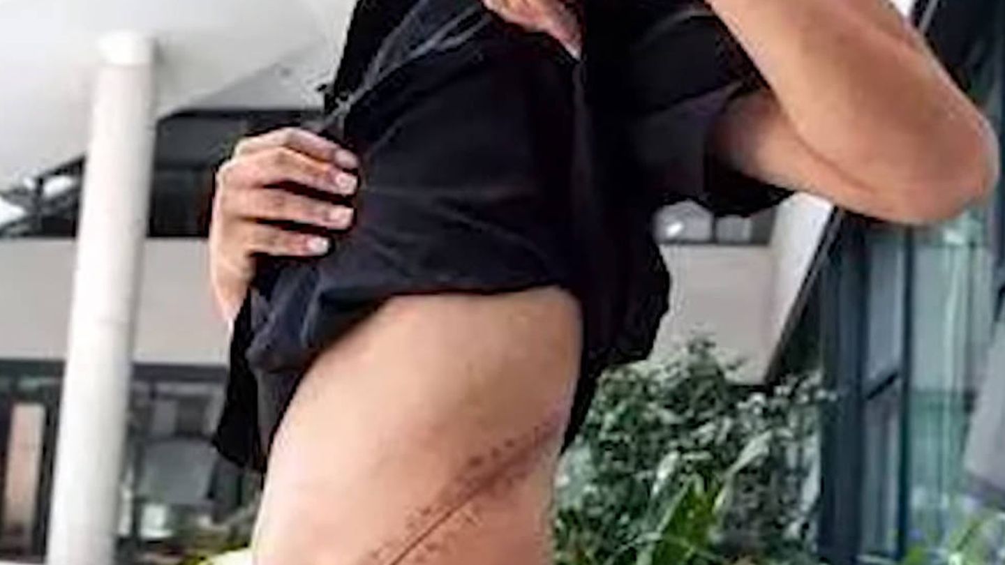 La cicatriz que le quedó tras la operación (Foto: YouTube)