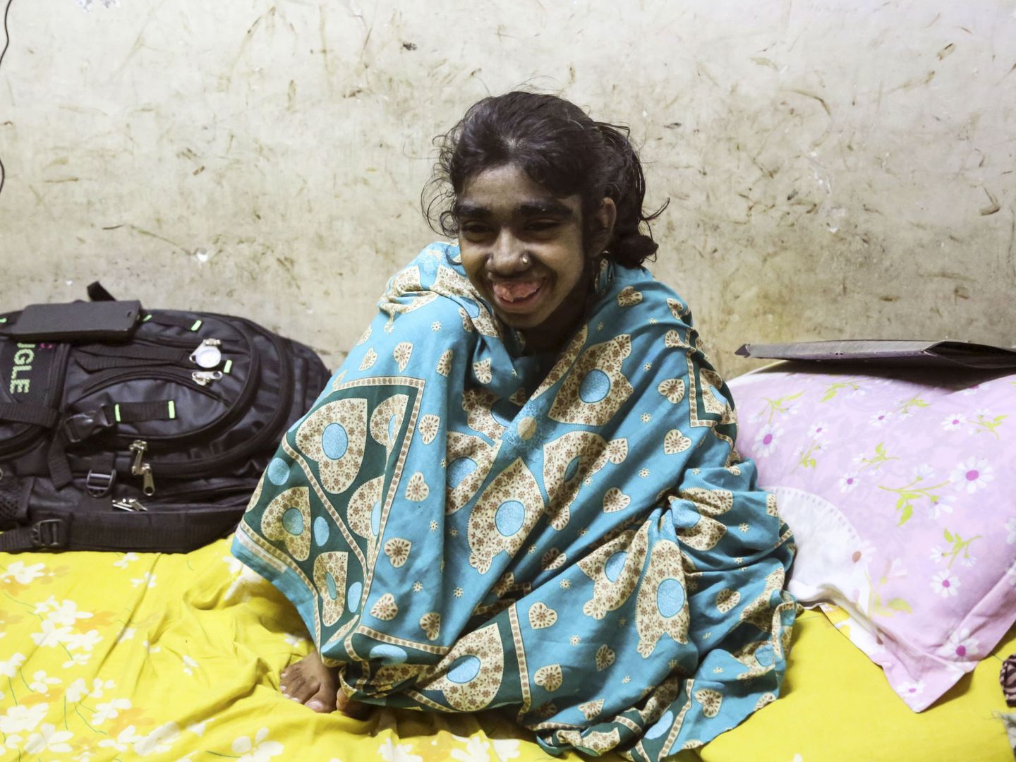 Una niña india afectada gravemente por el 'síndrome del hombre lobo' (EFE/Igor G. Barbero)