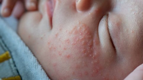 Tratar la dermatitis atópica del bebé reduce la alergia al huevo