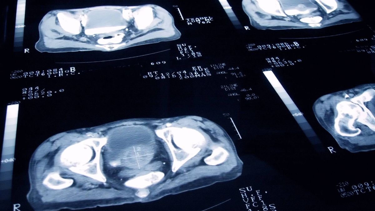 Un test para evaluar el riesgo del cáncer de próstata, el más frecuente entre los españoles