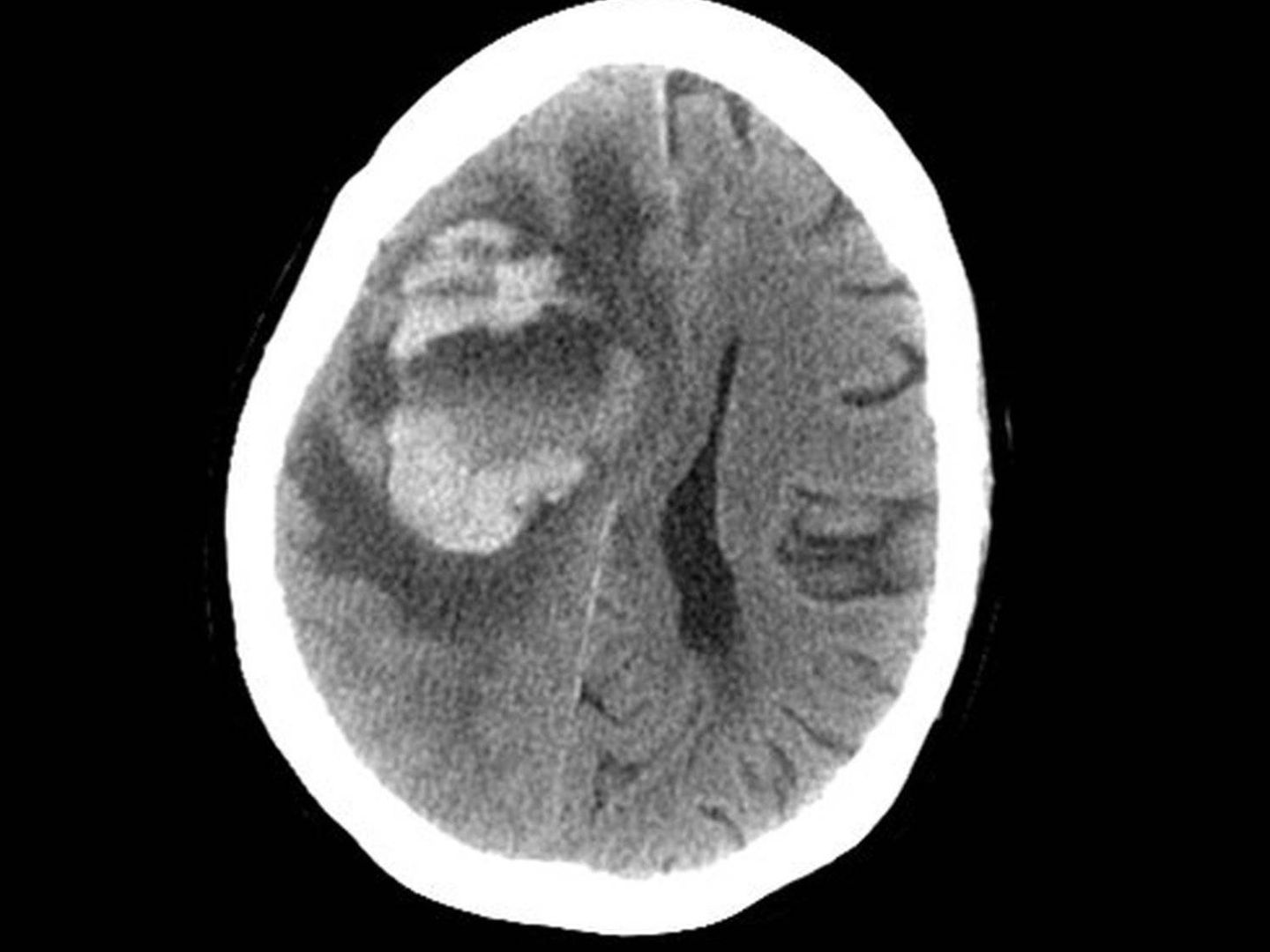 La infección de las amebas provocó una fuerte hemorragia en el cerebro. (Foto: Swedish Medical Center)