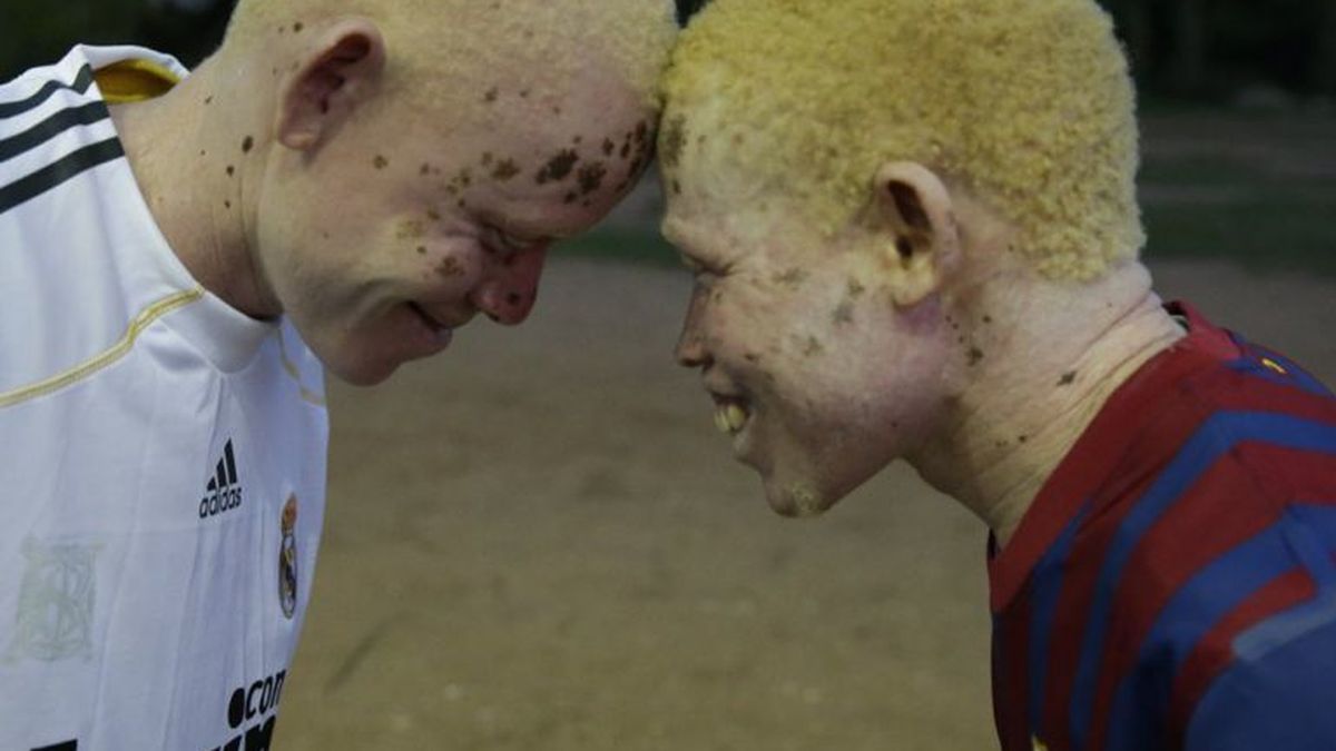 'Black man, white skin': el drama de los albinos que encuentran refugio en un balón