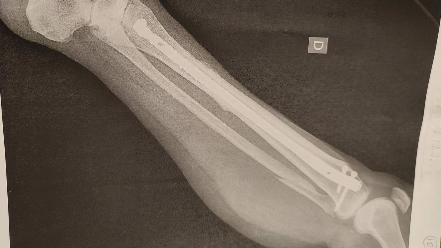 Radiografía de la pierna fracturada de la demandante. (EC)