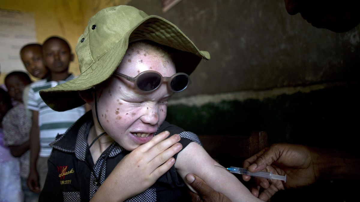 El horror de los albinos de Tanzania se recrudece con la mutilación de Yohana Bahati 