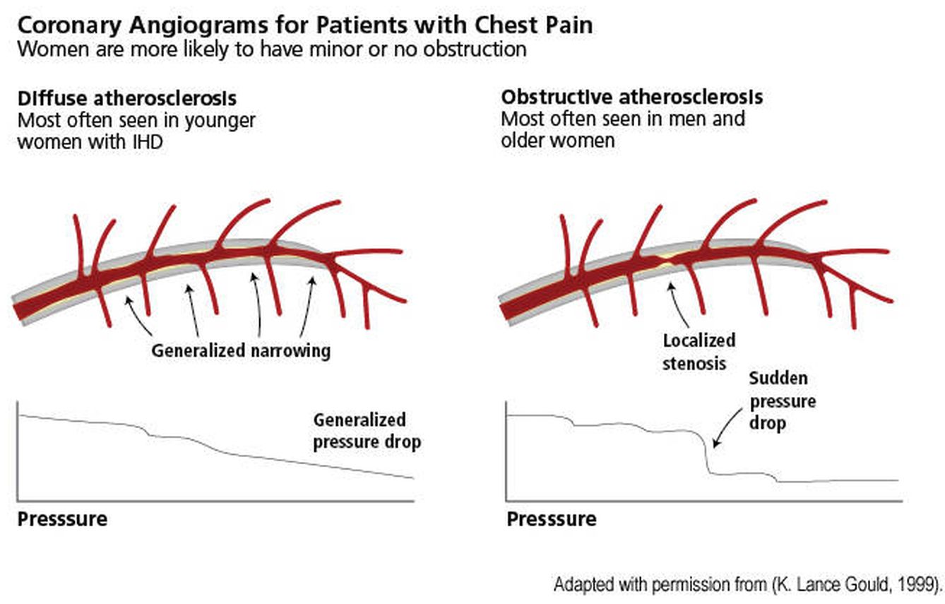Angiogramas coronarios de pacientes con dolor en el pecho (es más probable que las mujeres muestren obstrucciones menores o ninguna obstrucción)