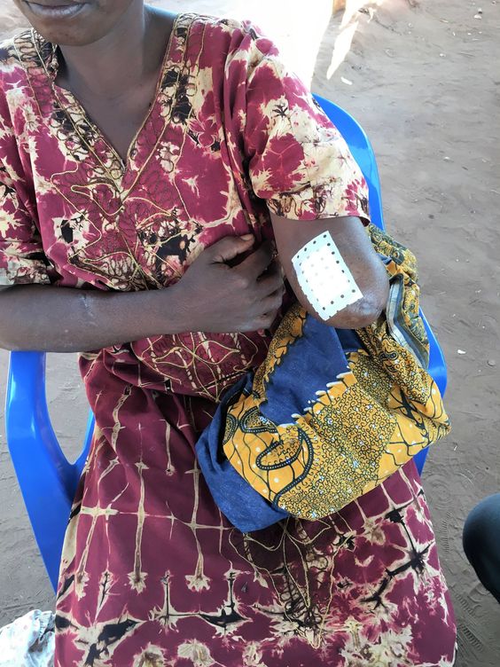 Víctima de un ataque de los Bana Mura, con un brazo amputado (Fuente: OHCHR)
