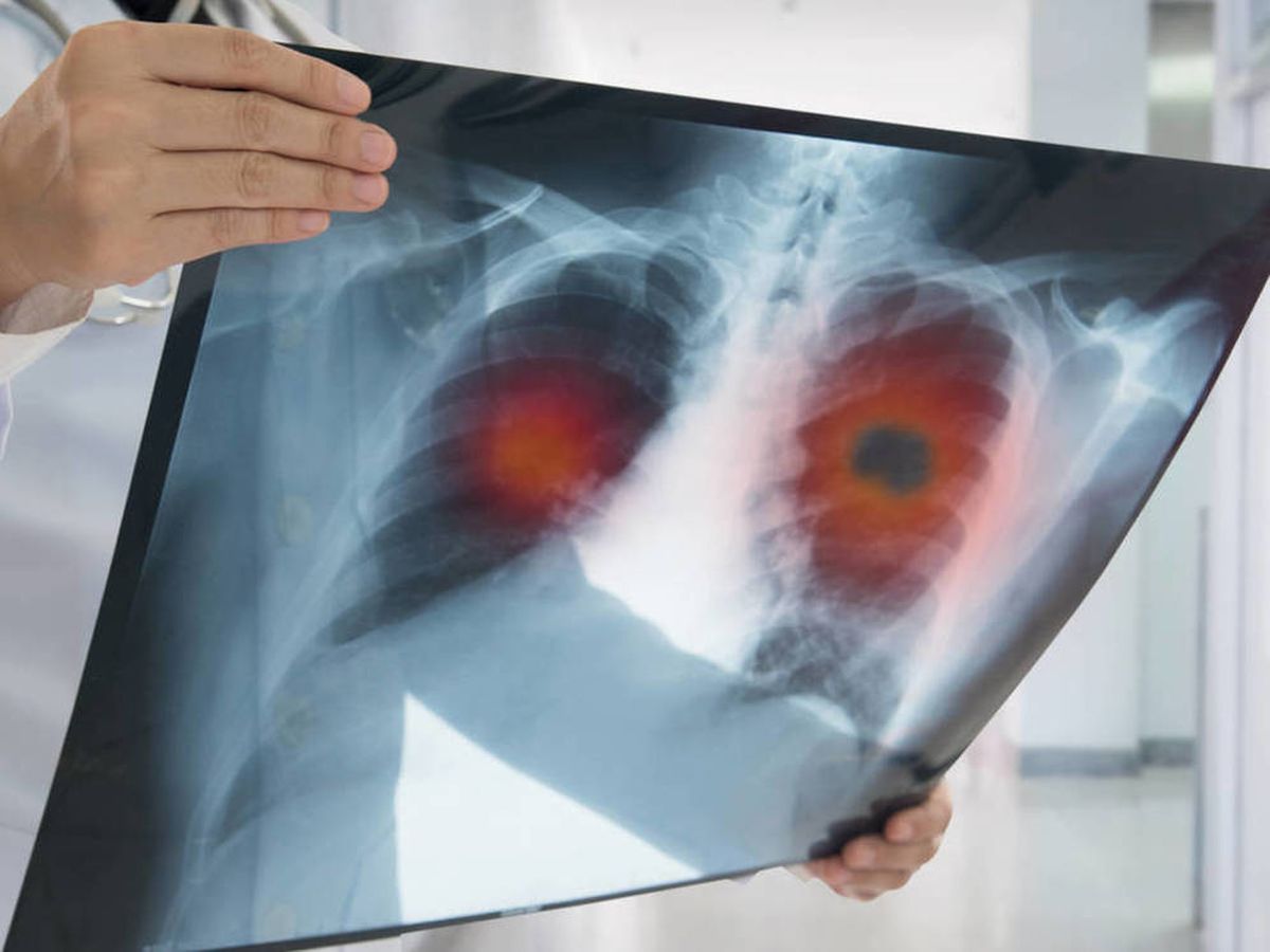 Foto: Una radiografía muestra un cáncer de pulmón. (iStock)