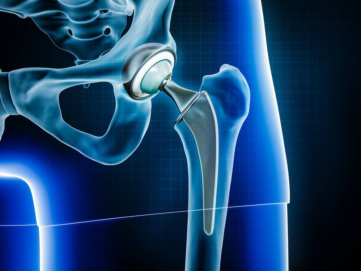 Foto: Una radiografía muestra una prótesis de cadera. (iStock)