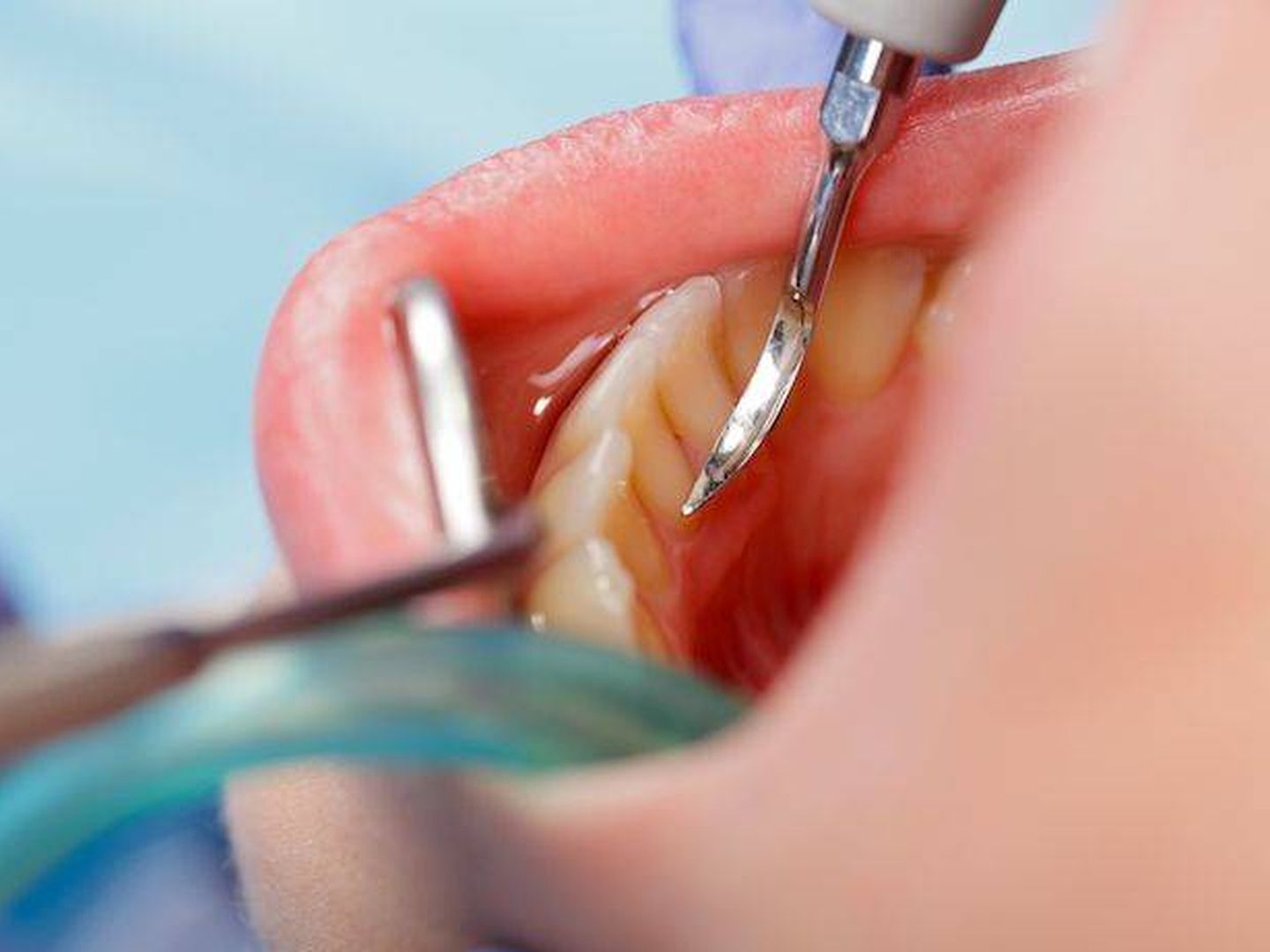 El curetaje dental es un complicado proceso de limpieza dental. (Foto: Clinica dental Avodent)