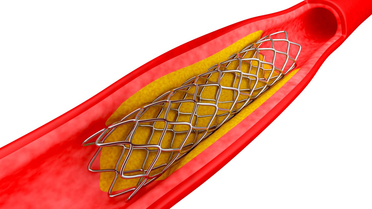 Ilustración de un 'stent'.
