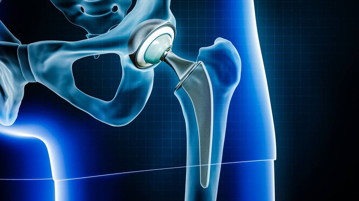 La Fiscalía pide indemnizar con 7 millones a pacientes afectados por prótesis de cadera