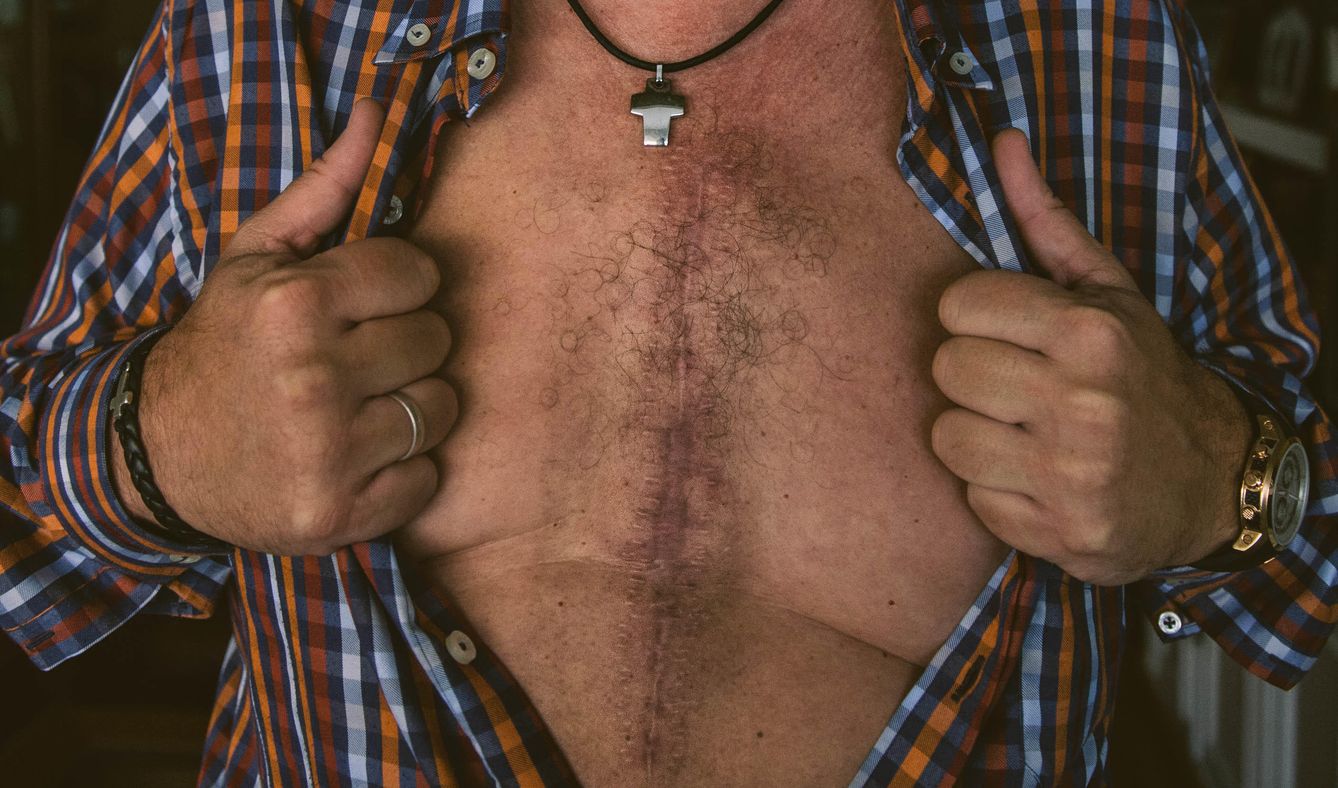 Chema muestra la cicatriz que le dejó la cirugía cardíaca. (Foto: Pablo López Learte)