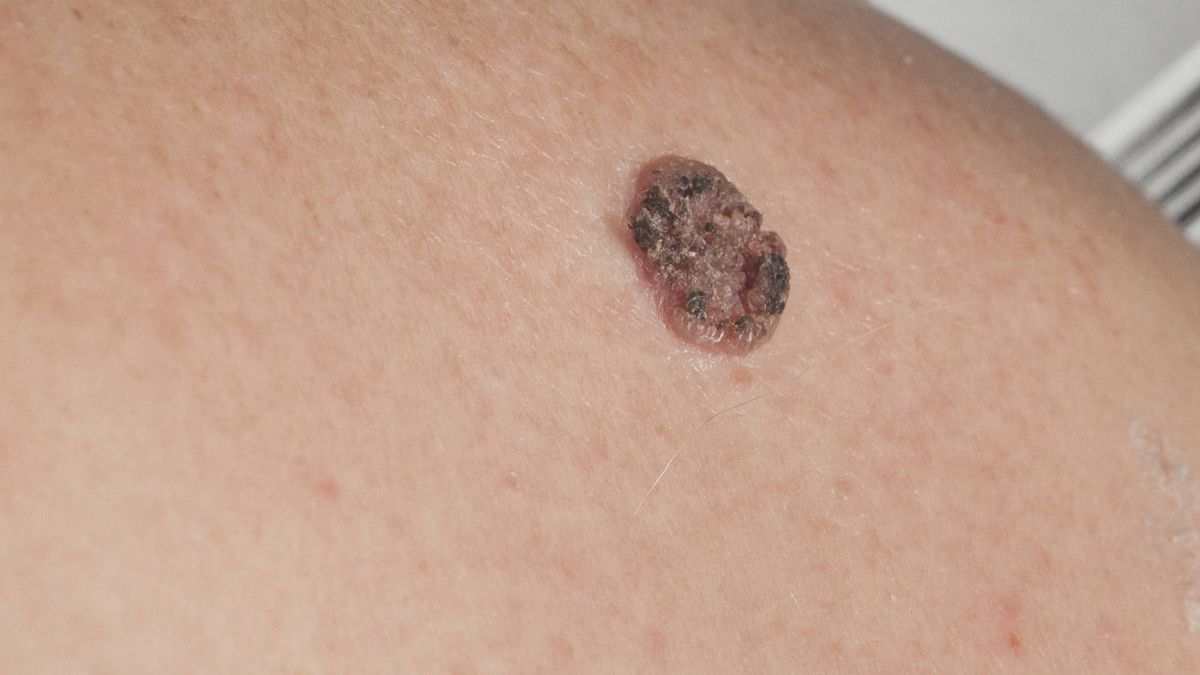 Los primeros signos  de que tu enfermedad es un melanoma