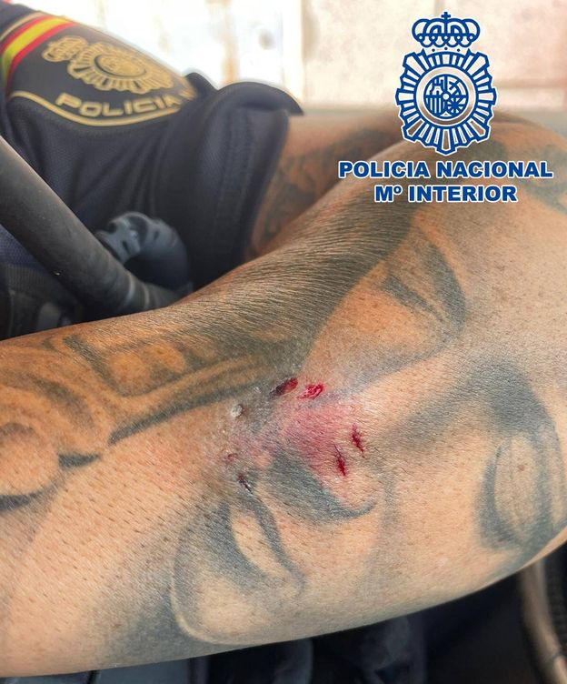 Foto: Mordisco sufrido por uno de los policías. (Policía Nacional)