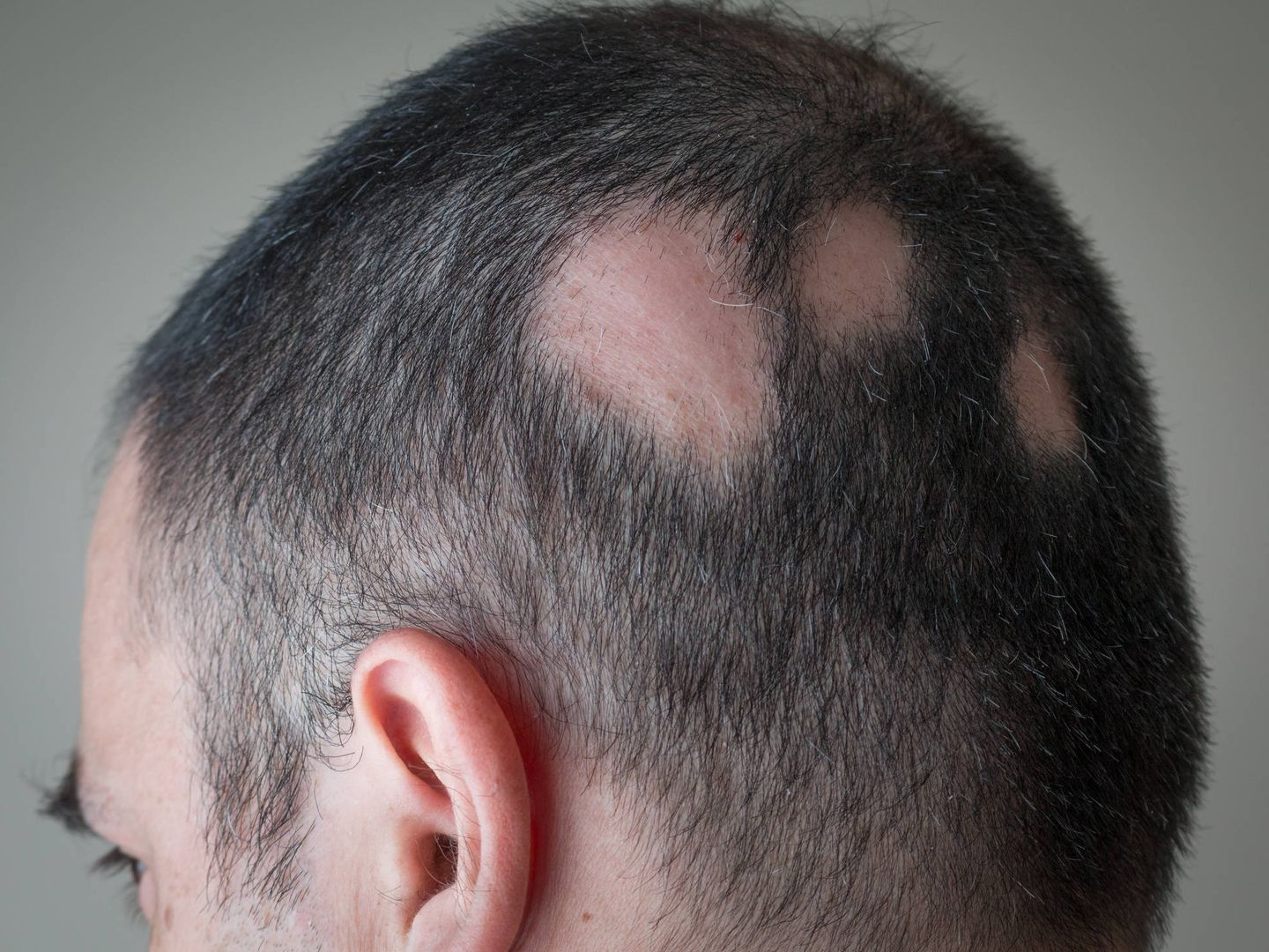Alopecia Aerata. (iStock)