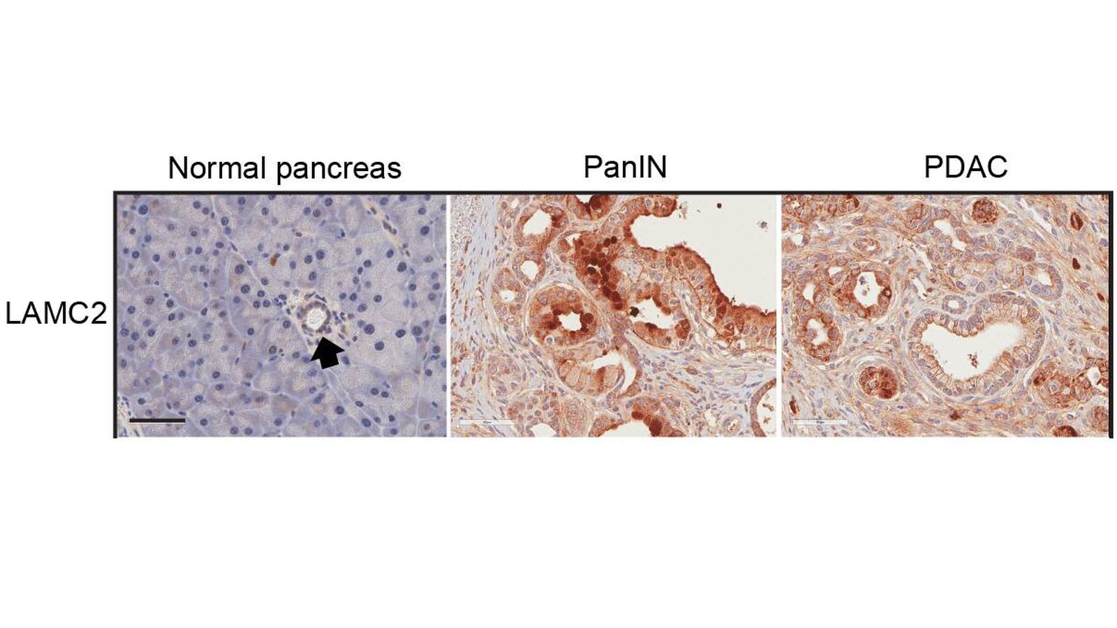 Imagen microscópica del gen LAMC2 (marrón) en tejido de páncreas normal, de tejido preneoplásico pancreático (PanIN) y en tejido tumoral de adenocarcinoma pancreático (PDAC).