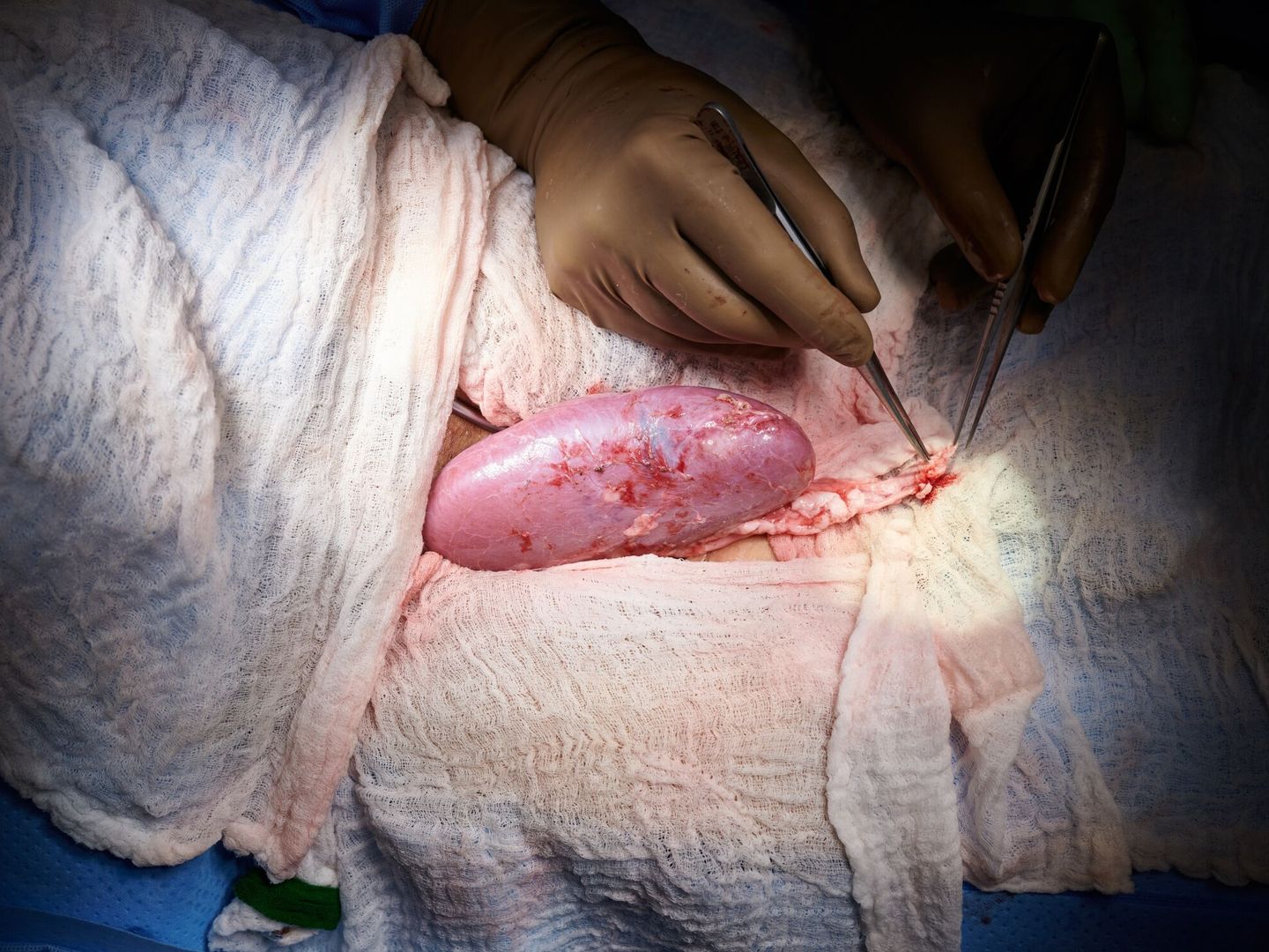 El riñón de cerdo utilizado en un trasplante humano en NY. (EFE)