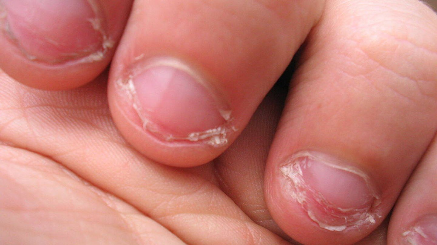 Morderse las uñas acaba deformando los dedos y las cutículas (Wikipedia/José Carlos Pace)