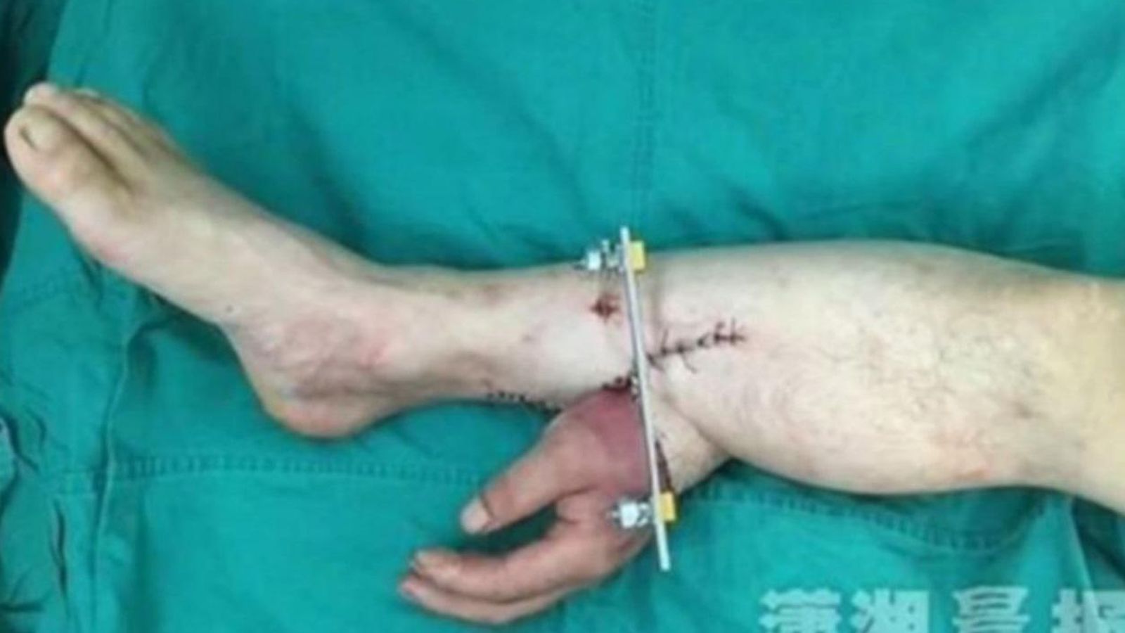 Foto: La mano guillotinada del paciente, unida a su pierna