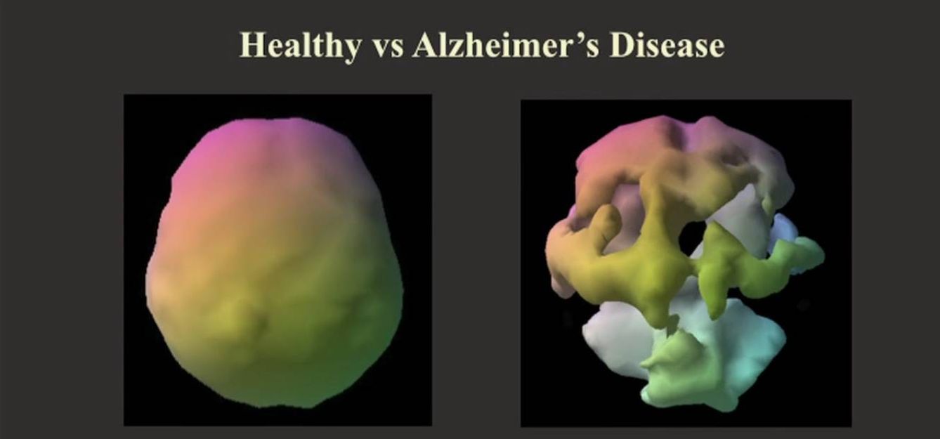  Diferencia del escáner de un cerebro sano y un cerebro de alguien con alzhéimer (Fuente: Daniel Amen)