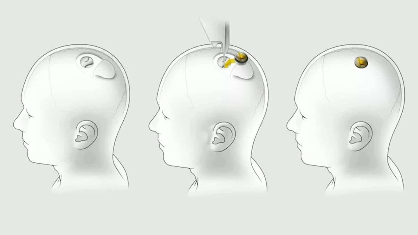 Así es como se inserta el implante en el cerebro. (Nerualink)