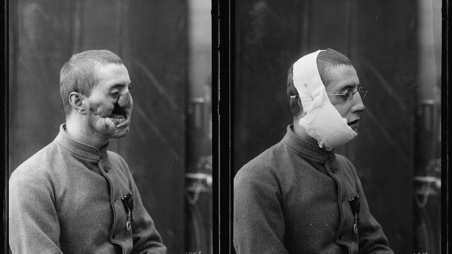 Antes y después de la operación y la colocación de la máscara de Ladd (Library of Congress)